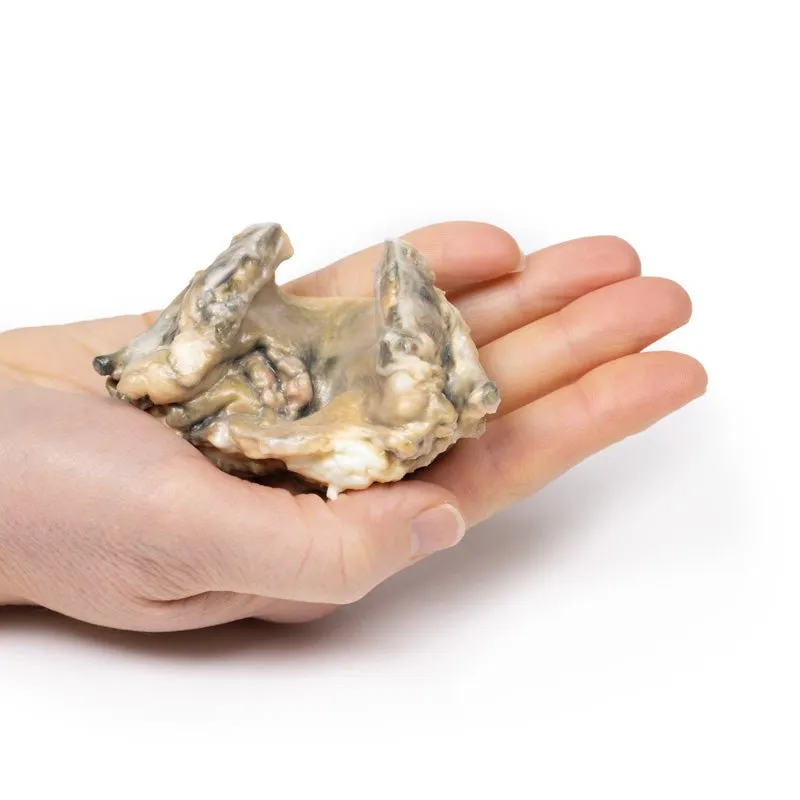3D Printed Carcinoma of Larynx with a 13 Month History of Dysphonia