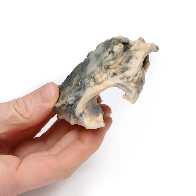 3D Printed Carcinoma of Larynx with a 13 Month History of Dysphonia