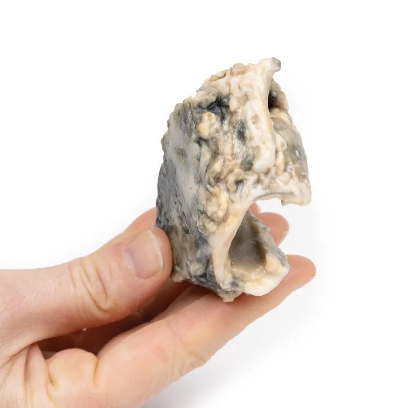 3D Printed Carcinoma of Larynx with a 13 Month History of Dysphonia