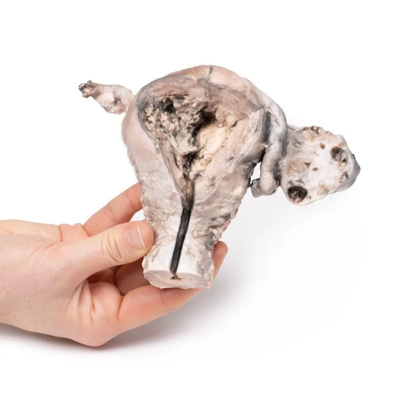 3D Printed Endometrial Carcinoma
