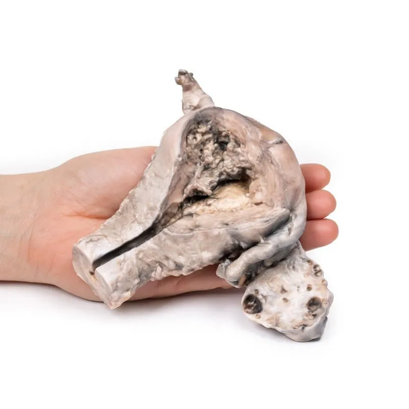 3D Printed Endometrial Carcinoma