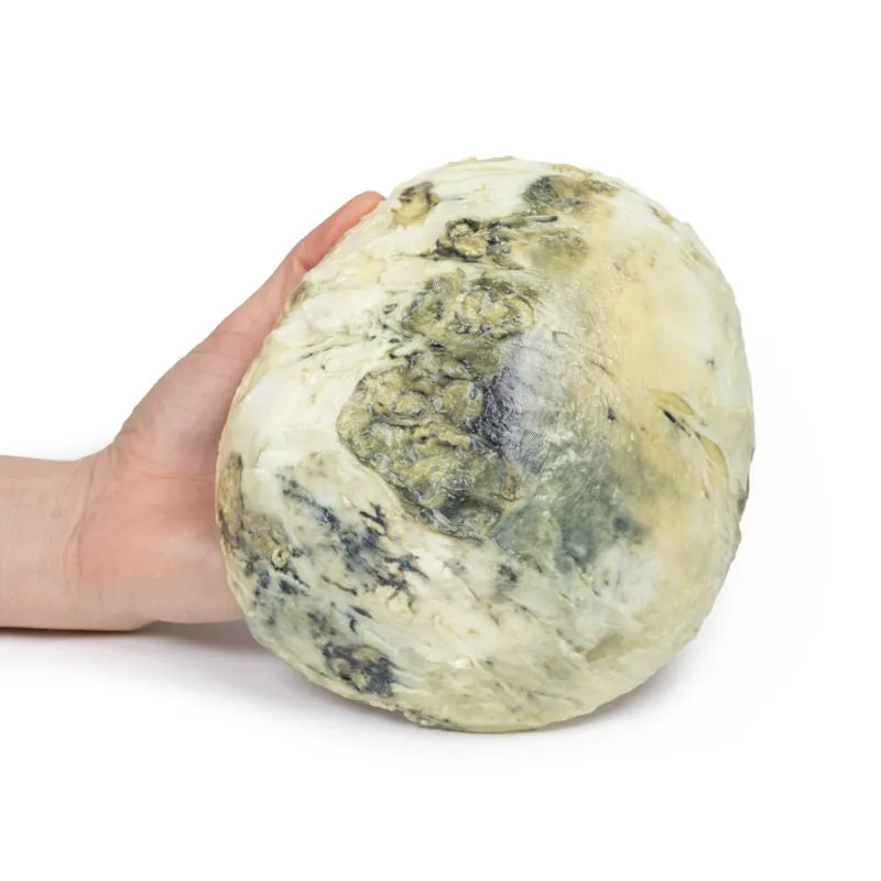 3D Printed Tertiary Syphilis