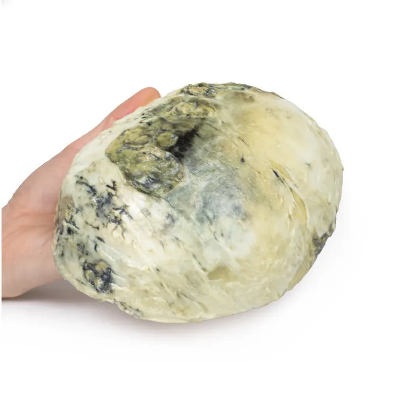 3D Printed Tertiary Syphilis